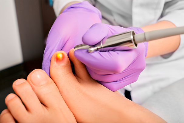 Fungal nail laser the best treatment for fungal toenails and onychomycosis?