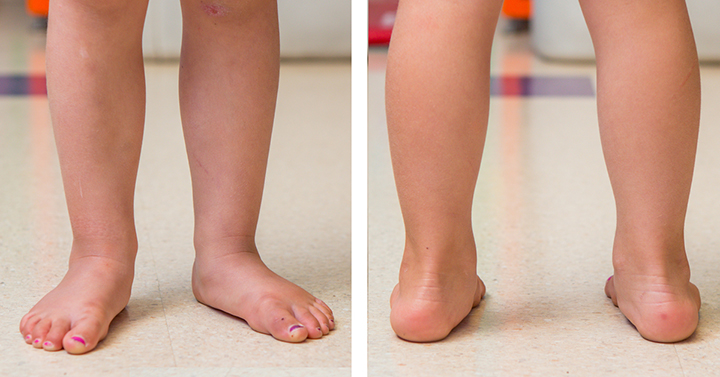 kids flat foot treatment