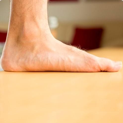 how to treat flat feet