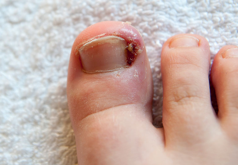 how to treat painful ingrown toenail