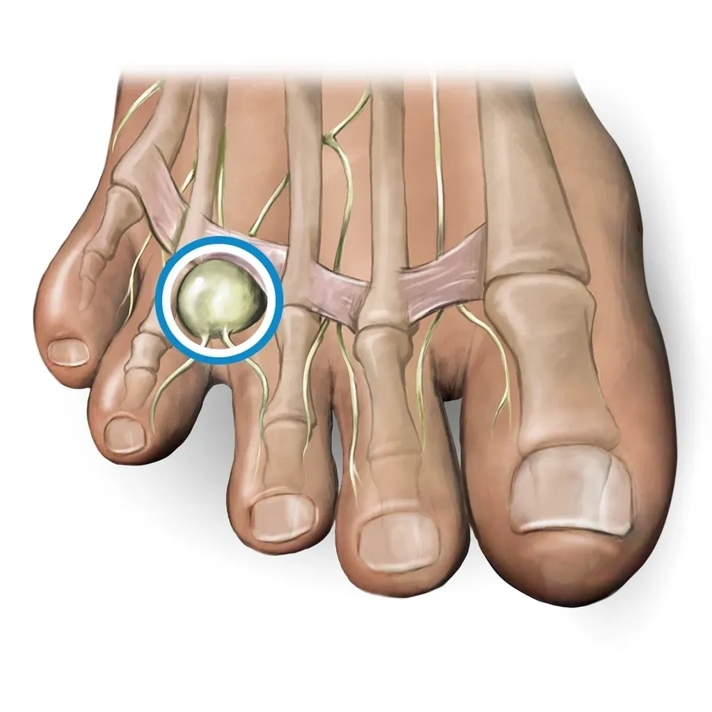 Mortons neuroma pain and treatment