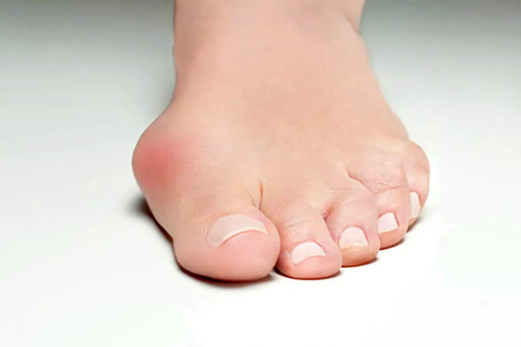 bunion treatment and pain relief