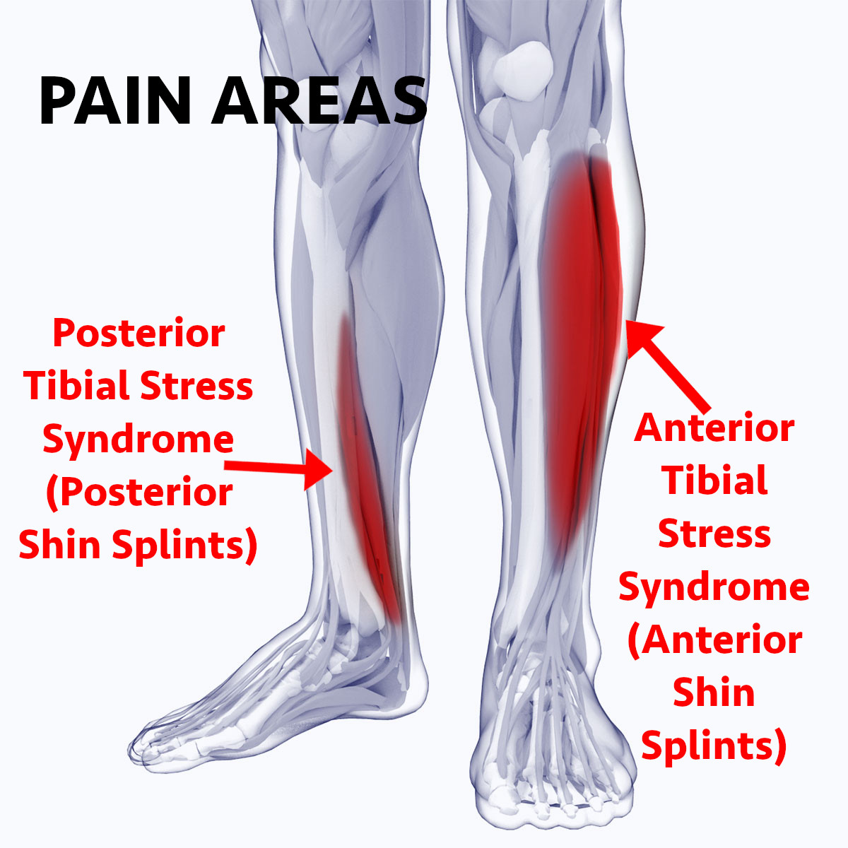 what is posterior tibial stress syndrome and how to fix it