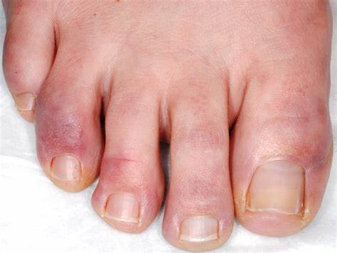 how to look after my feet with chilblains