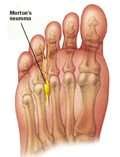 Morton's neuroma causing ball of foot pain metatarsalgia tingling nerve numbness