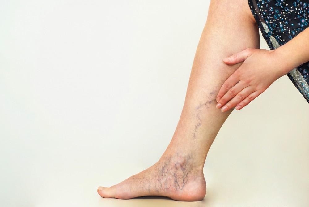 venous insufficiency varicose veins legs and feet